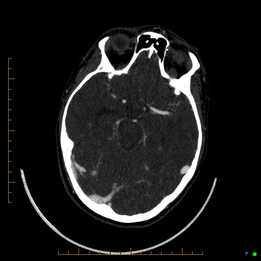Cerebral arteriovenous malformation (AVM) (Radiopaedia 78162-90706 Axial CTA 113).jpg