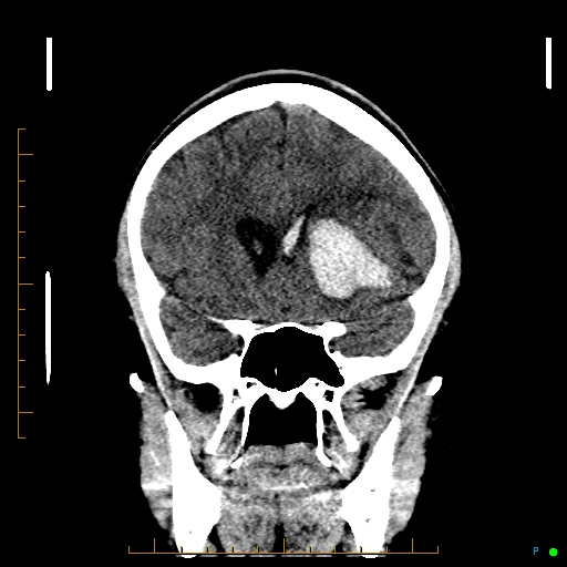 Cerebral arteriovenous malformation (AVM) (Radiopaedia 78162-90706 Coronal non-contrast 36).jpg