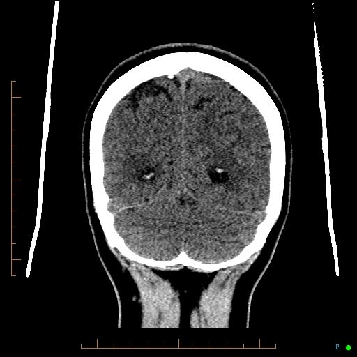 File:Cerebral arteriovenous malformation (AVM) (Radiopaedia 78162-90706 Coronal non-contrast 80).jpg