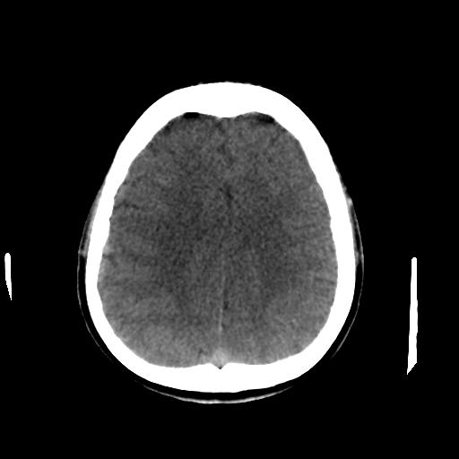 Cerebral arteriovenous malformation (Radiopaedia 28518-28759 Axial non-contrast 52).jpg