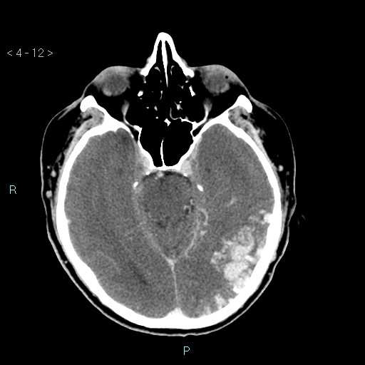 File:Cerebral arteriovenous malformation (Radiopaedia 40528-43125 Axial C+ delayed 12).jpg