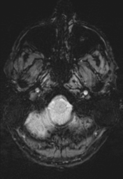 File:Cerebral arteriovenous malformation (Radiopaedia 55798-62372 Axial SWI 3).png