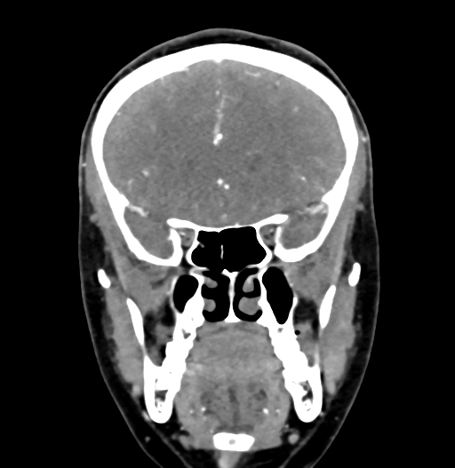 Cerebral arteriovenous malformation (Radiopaedia 73830-84645 C 32).jpg