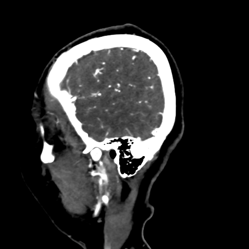 File:Cerebral arteriovenous malformation (Radiopaedia 73830-84645 Sagittal C+ delayed 79).jpg