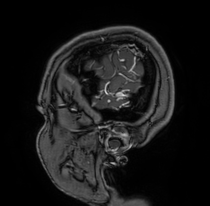 Cerebral arteriovenous malformation (Radiopaedia 74411-85654 Sagittal T1 C+ 6).jpg