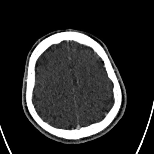 Cerebral arteriovenous malformation (Radiopaedia 78188-90746 Axial C+ delayed 140).jpg