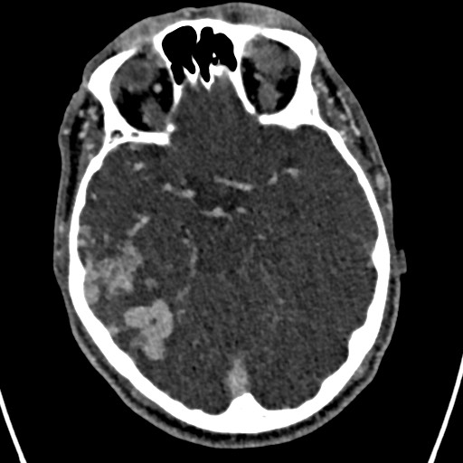 Cerebral arteriovenous malformation (Radiopaedia 78188-90746 Axial C+ delayed 66).jpg