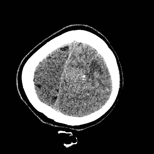 Cerebral arteriovenous malformation (Radiopaedia 79677-92887 Axial non-contrast 51).jpg