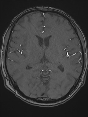 Cerebral arteriovenous malformation (Radiopaedia 84015-99245 Axial TOF 131).jpg