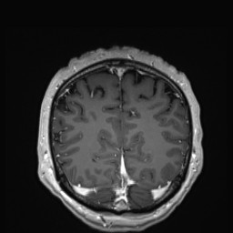 Cerebral arteriovenous malformation (Radiopaedia 84015-99245 Coronal T1 C+ 132).jpg