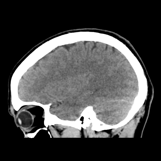 File:Cerebral arteriovenous malformation (Spetzler-Martin grade 2) (Radiopaedia 41262-44076 A 44).png