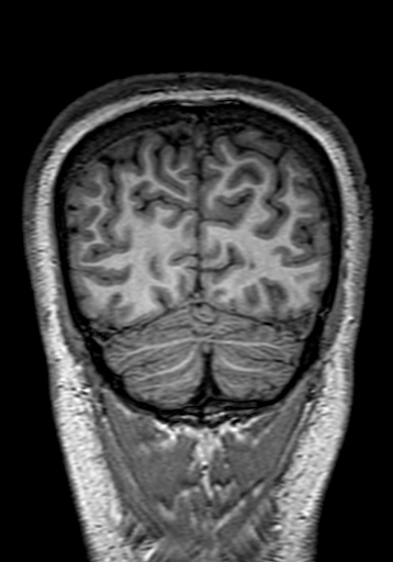 Cerebral arteriovenous malformation at posterior body of corpus callosum (Radiopaedia 74111-84925 Coronal T1 302).jpg