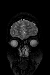 Cerebral arteriovenous malformation at posterior body of corpus callosum (Radiopaedia 74111-84925 Coronal T2 15).jpg