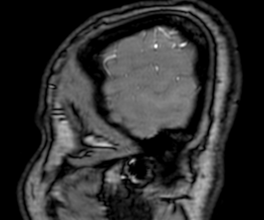 File:Cerebral arteriovenous malformation at posterior body of corpus callosum (Radiopaedia 74111-84925 J 2).jpg
