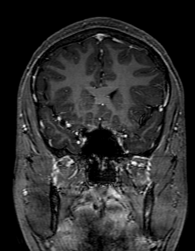 Cerebral arteriovenous malformation at posterior body of corpus callosum (Radiopaedia 74111-84925 K 118).jpg