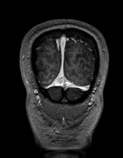 Cerebral arteriovenous malformation at posterior body of corpus callosum (Radiopaedia 74111-84925 K 344).jpg