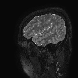 Cerebral arteriovenous malformation at posterior body of corpus callosum (Radiopaedia 74111-84925 Sagittal T2 116).jpg