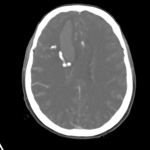 Cerebral arteriovenous malformation with hemorrhage (Radiopaedia 28773-29073 A 22).jpg