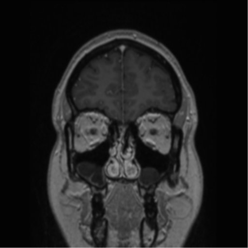 Cerebral cavernoma and development venous anomaly (Radiopaedia 37603-39482 Coronal T1 C+ 78).png