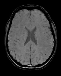 Cerebral cavernous venous malformation (Radiopaedia 70008-80021 I 46).jpg
