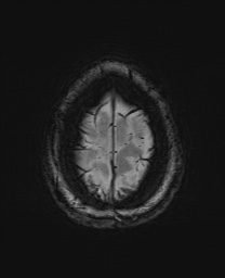 Cerebral cavernous venous malformation (Radiopaedia 70008-80021 I 69).jpg