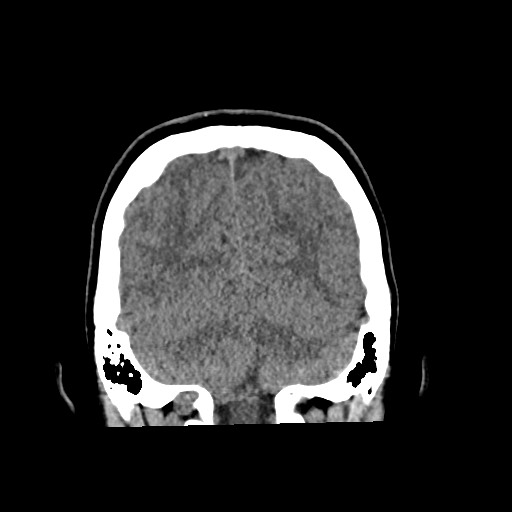 Cerebral cavernous venous malformation (Radiopaedia 70008-80022 non-contrast 55).jpg