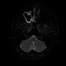 Cerebral cavernous venous malformation (Zabramski type II) (Radiopaedia 85511-101198 Axial DWI 72).jpg