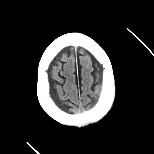 File:Cerebral contusions, subarachnoid hemorrhage and subdural hygromas (Radiopaedia 55399-61829 Axial non-contrast 7).png