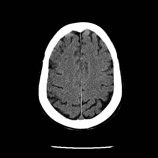 Cerebral edema (evolution in time) (Radiopaedia 19418-19441 non-contrast 72).jpg