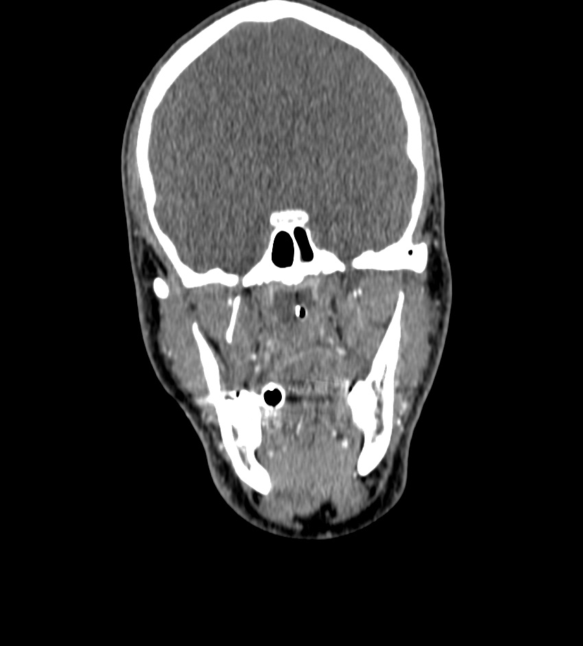 Cerebral edema in an overdose patient (Radiopaedia 72005-82539 B 17).jpg