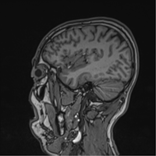 Cerebral fat embolism (Radiopaedia 57697-64639 Sagittal T1 17).png