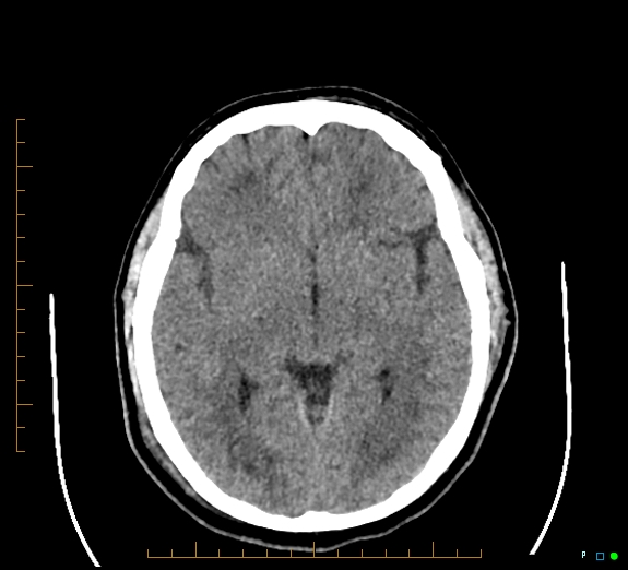 Cerebral fat embolism (Radiopaedia 85521-101220 Axial non-contrast 31).jpg