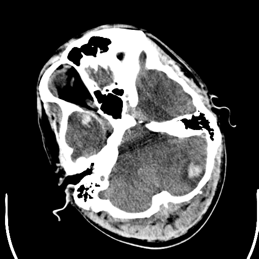 File:Cerebral hemorrhagic contusions- temporal evolution (Radiopaedia 40224-42752 Axial non-contrast 5).png