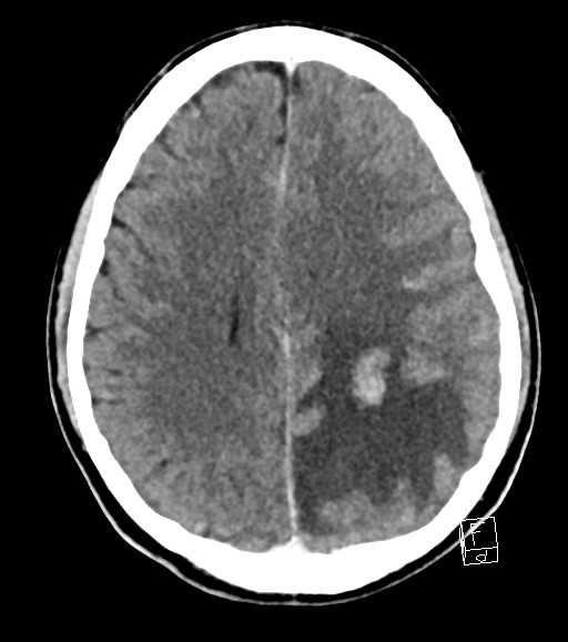 Cerebral metastases - testicular choriocarcinoma (Radiopaedia 84486-99855 Axial C+ delayed 22).jpg