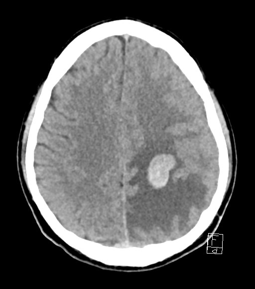 Cerebral metastases - testicular choriocarcinoma (Radiopaedia 84486-99855 Axial non-contrast 20).jpg