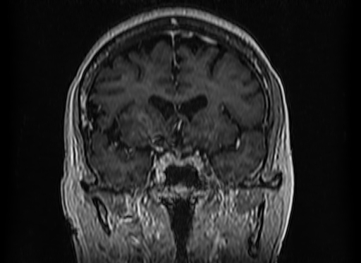 Cerebral metastases from lung cancer with amyloid angiopathy and cerebellopontine angle meningioma (Radiopaedia 74306-85191 Coronal T1 C+ 22).jpg