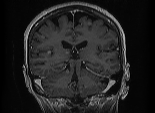 Cerebral metastases from lung cancer with amyloid angiopathy and cerebellopontine angle meningioma (Radiopaedia 74306-85191 Coronal T1 C+ 37).jpg
