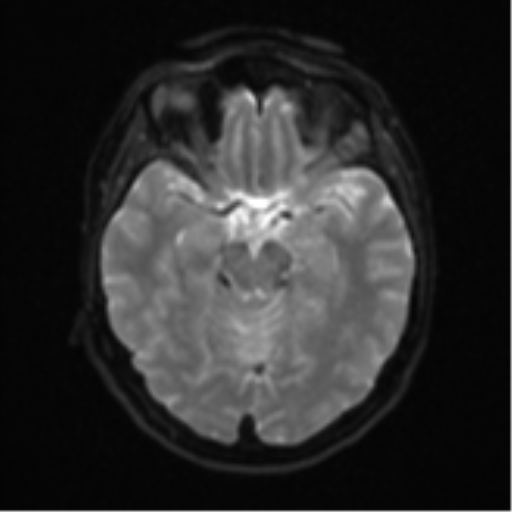 Cerebral metastases mimicking abscesses (Radiopaedia 45841-50131 Axial DWI 12).png
