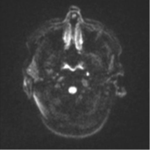 Cerebral metastases mimicking abscesses (Radiopaedia 45841-50131 Axial DWI 31).png
