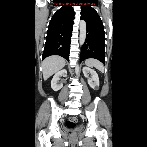 Cerebral metastasis - colorectal carcinoma (Radiopaedia 8581-83548 A 55).jpg