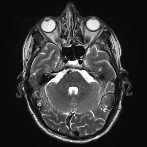 File:Cerebral metastasis - melanoma (Radiopaedia 54718-60954 Axial T2 9).png