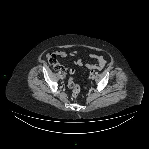 File:Cerebral metastasis from renal cell carcinoma (Radiopaedia 82306-96378 A 157).jpg