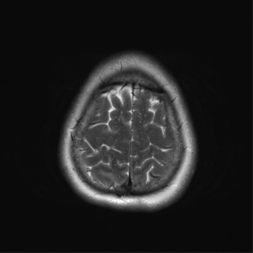 File:Cerebral metastasis mimicking glioblastoma (Radiopaedia 69155-78937 Axial T2 36).png