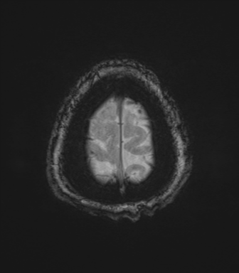 Cerebral metastasis to basal ganglia (Radiopaedia 81568-95413 Axial SWI magnitude 83).png
