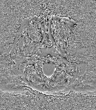 Cerebral metastasis to basal ganglia (Radiopaedia 81568-95413 Axial SWI phase 3).png