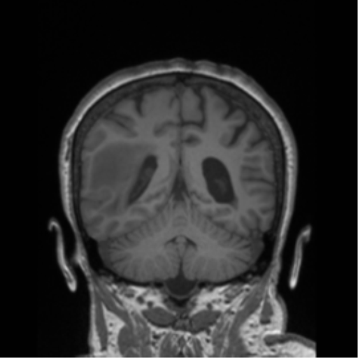 Cerebral metastasis to basal ganglia (Radiopaedia 81568-95413 Coronal T1 10).png