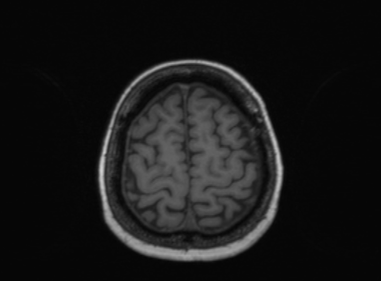 Cerebral ring enhancing lesions - cerebral metastases (Radiopaedia 44922-48817 Axial T1 132).jpg