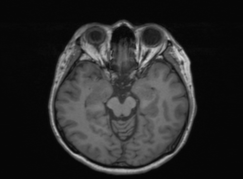 Cerebral ring enhancing lesions - cerebral metastases (Radiopaedia 44922-48817 Axial T1 262).jpg