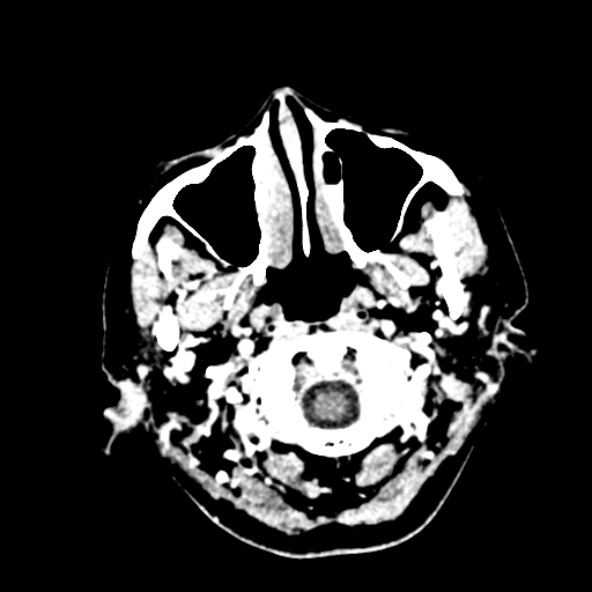 Cerebral ring enhancing lesions - cerebral metastases (Radiopaedia 44922-48818 B 14).jpg