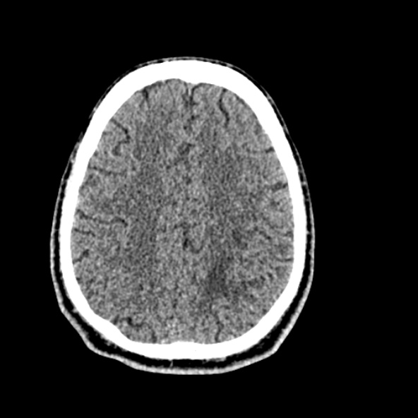 Cerebral toxoplasmosis (Radiopaedia 53993-60131 Axial non-contrast 59).jpg